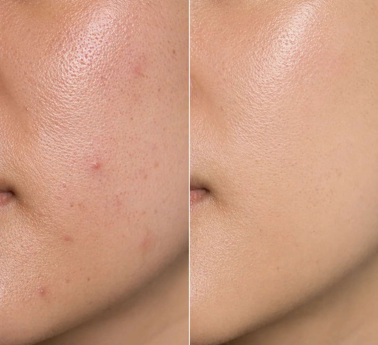 Patchs Anti-Acné Hydrocolloïdes