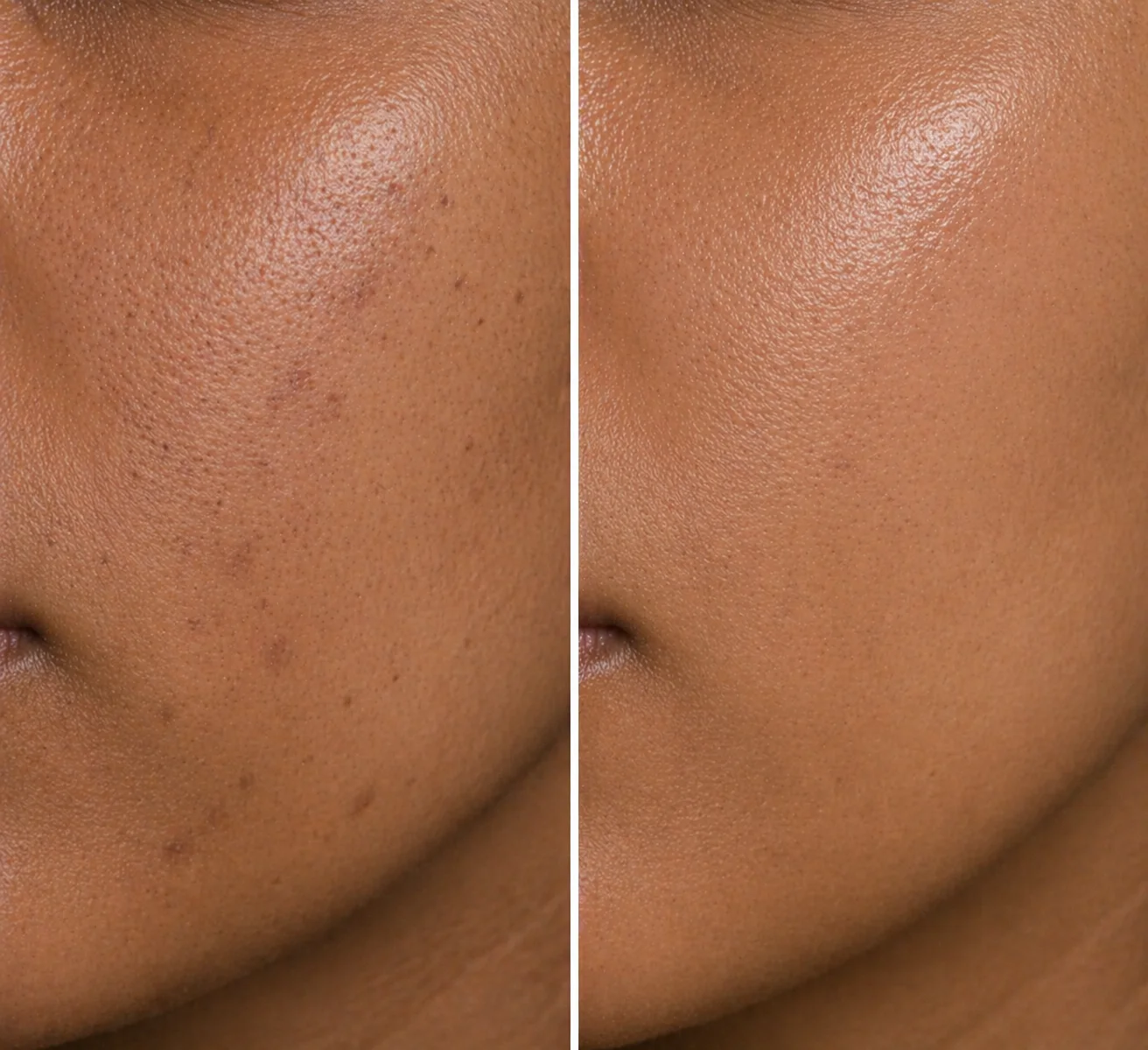 Patchs Anti-Acné Hydrocolloïdes