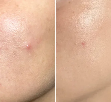 Patchs Anti-Acné Hydrocolloïdes