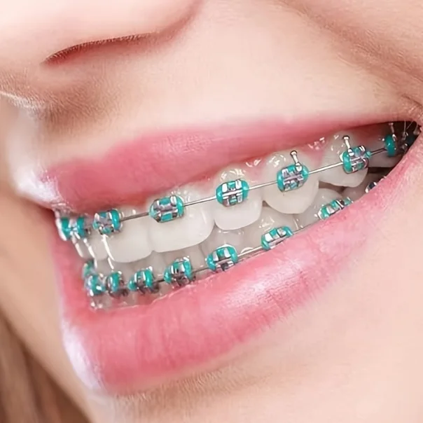 أبهر أصدقائك وأفراد عائلتك اليوم  مع تقويم الأسنان الأنيق لي كيتركب وكيتزير بسهولة بألوان مختلفة