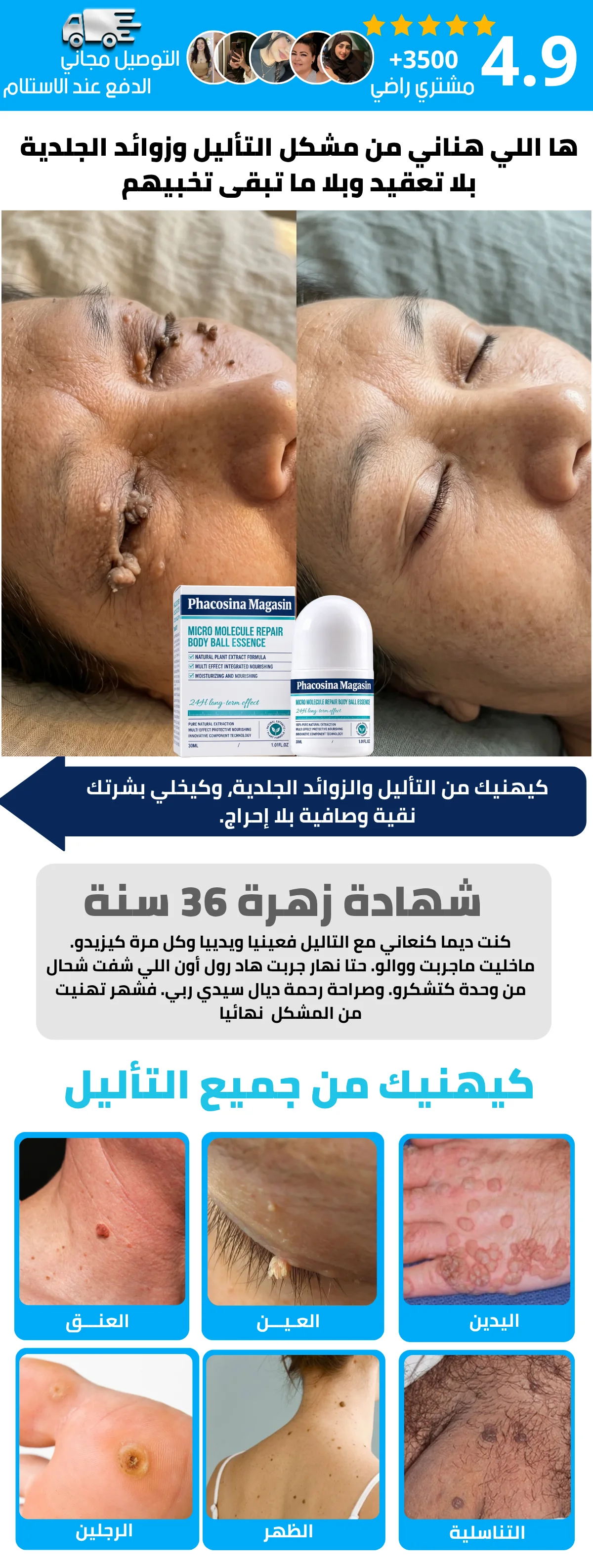 skin tag phaosina