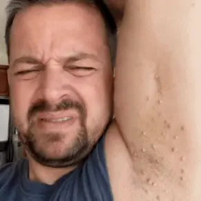 tik skin tag phaosin